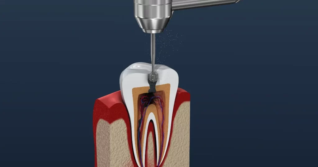 7 Mistakes You Know About Root Canal Treatment