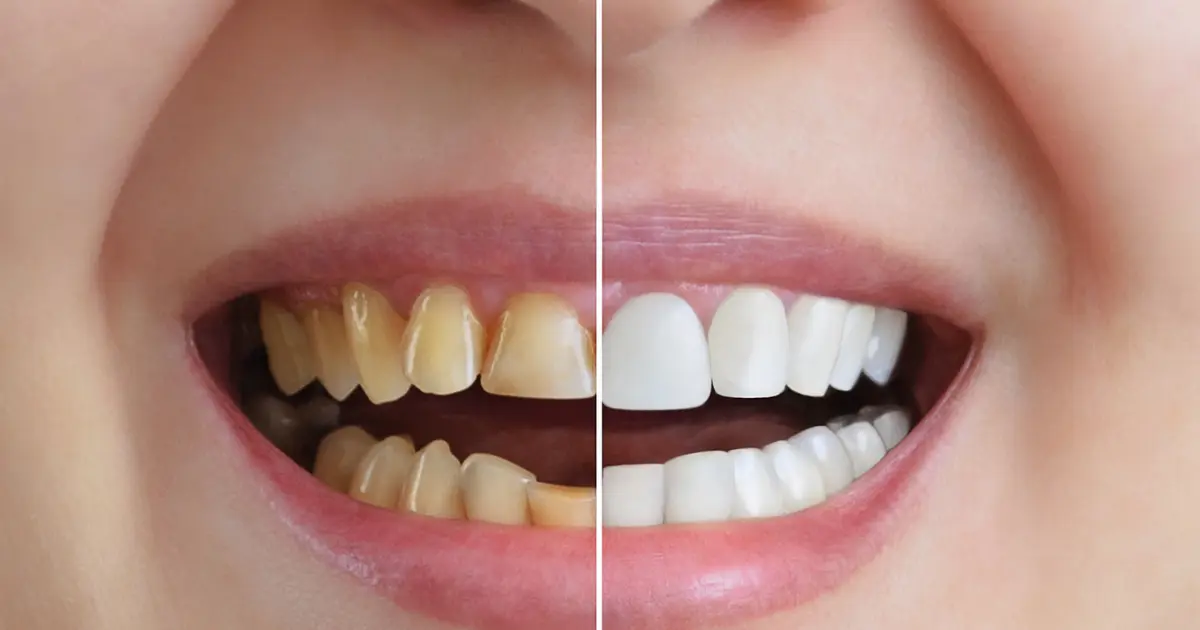 teeth straightening