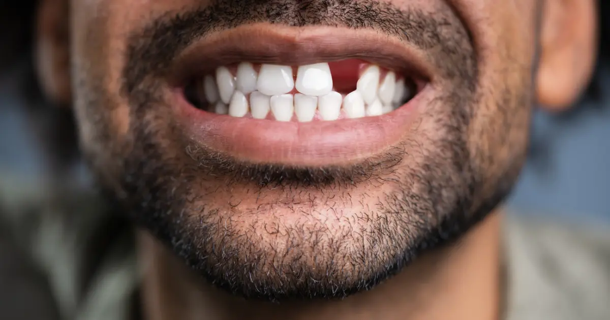 missing teeth