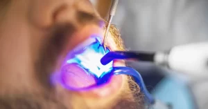 diş dolgusu çeşitleri