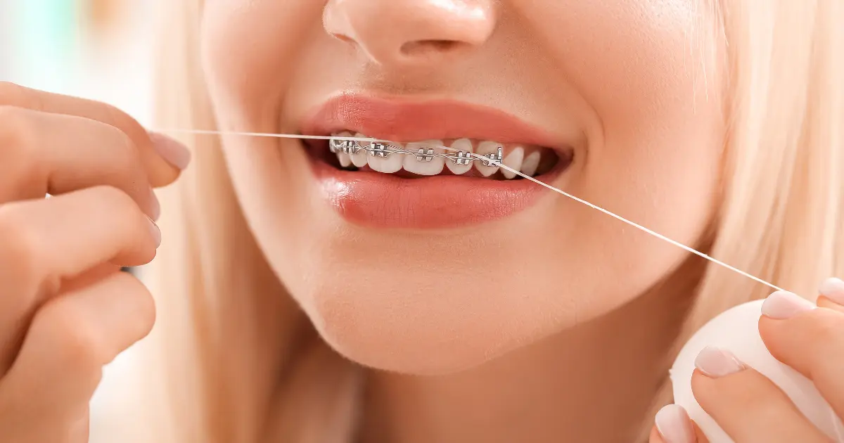 Diş Teli Varken Diş Temizliği Nasıl Yapılır?