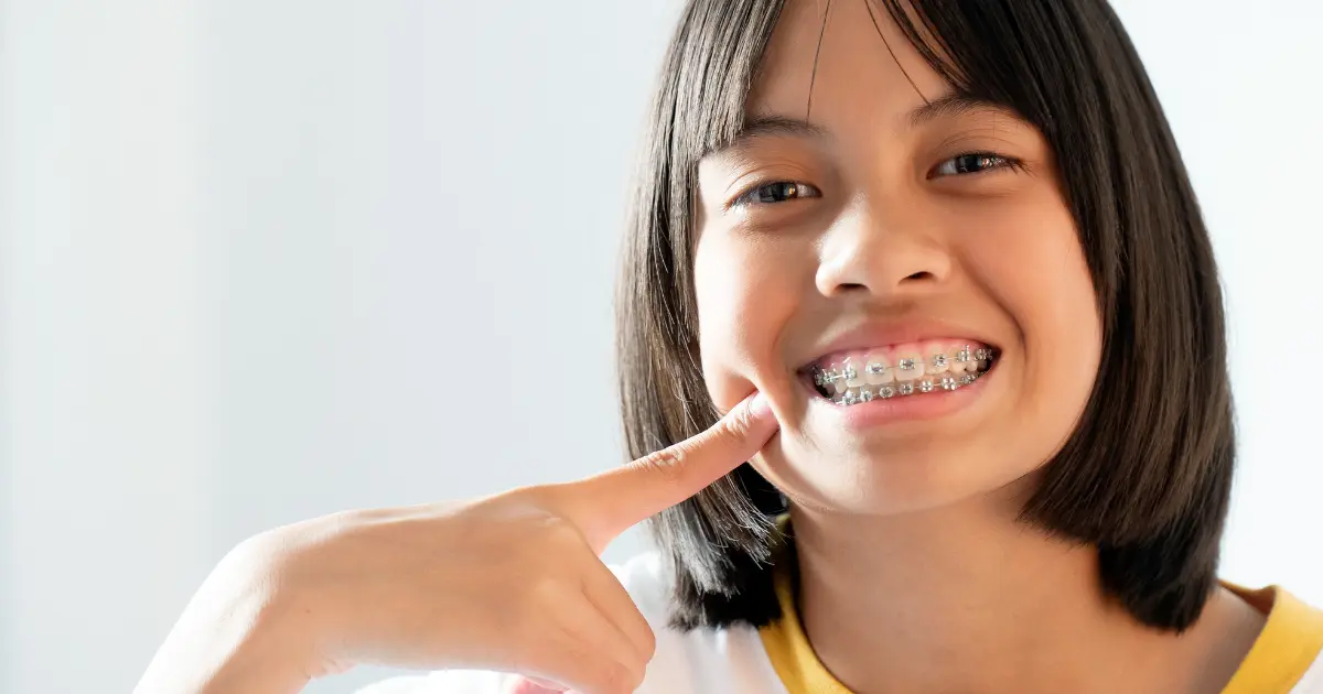 Is Teeth Whitening Done When There Are Braces