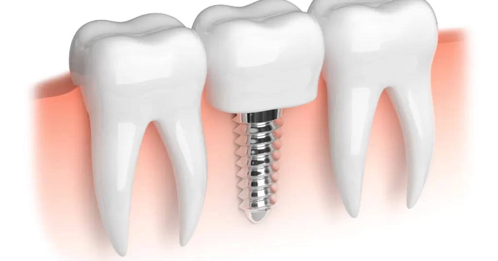 types implants dentaires