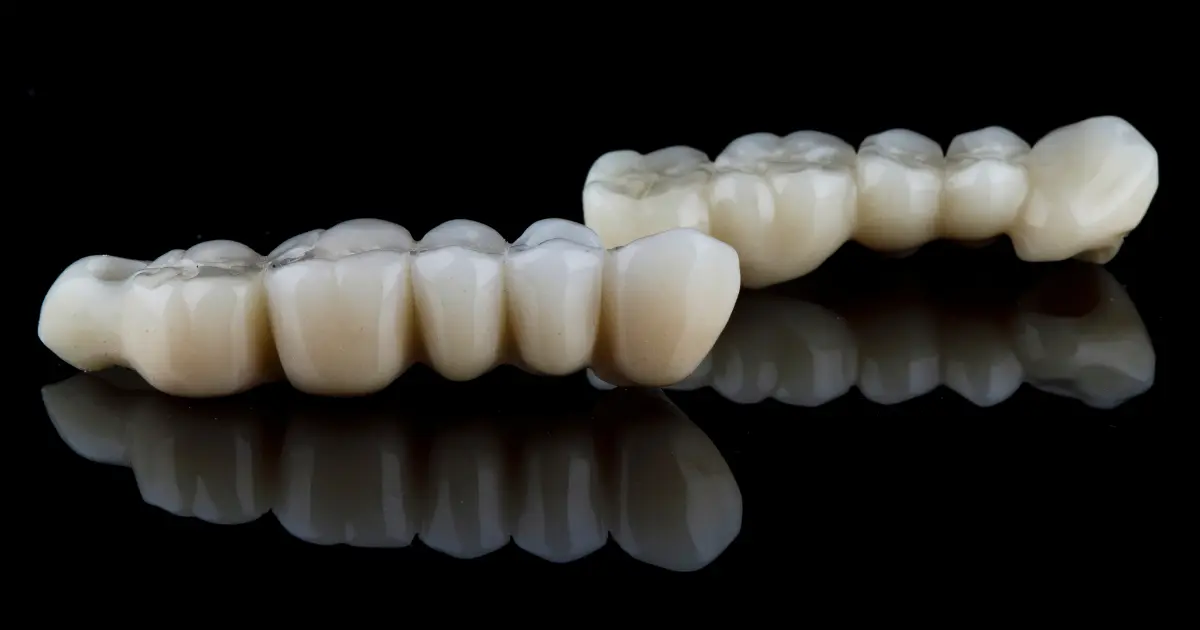 le pont dentaire et implant