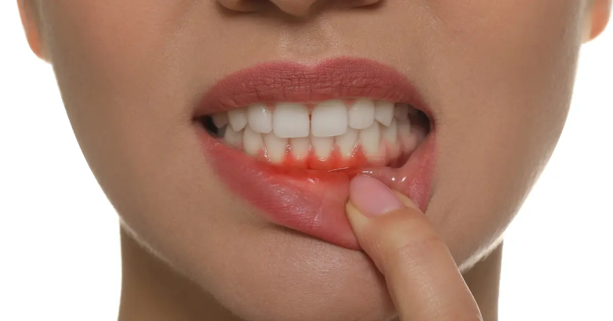 dental diseases