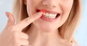 What Causes Bleeding Gums?