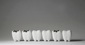 dental erosion