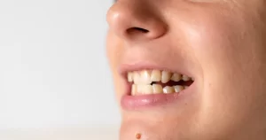 malocclusion