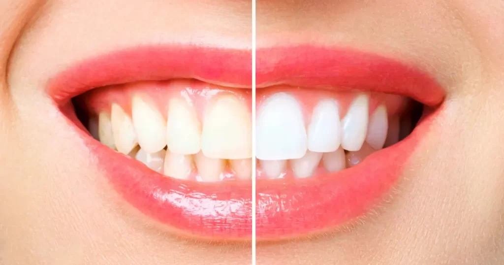 What is Teeth Whitening How