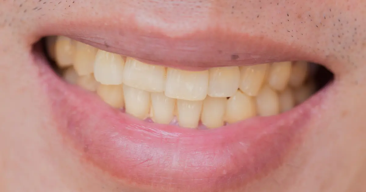 tooth discoloration