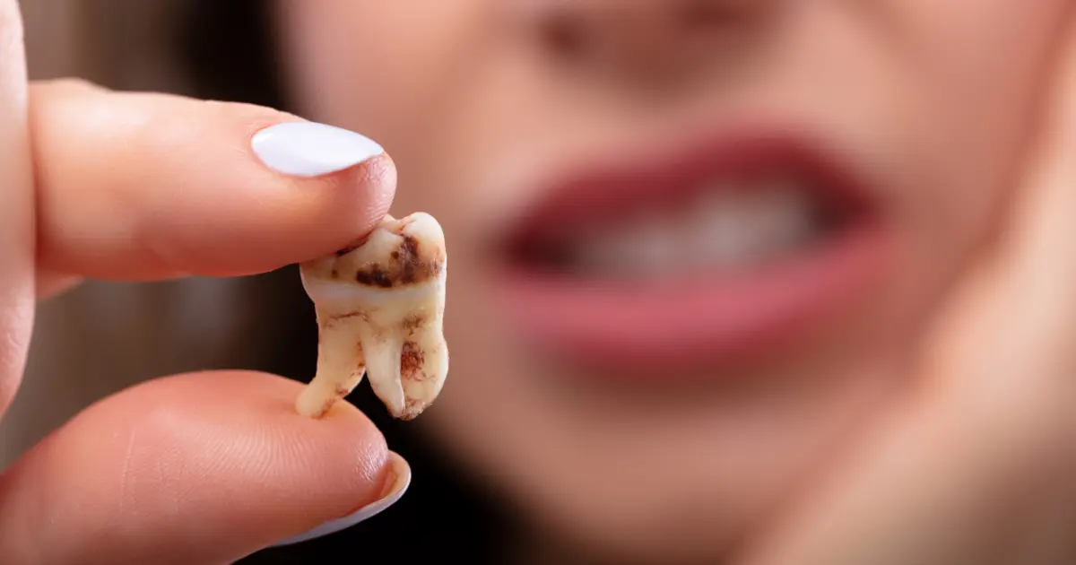 What Rots the Teeth the Most?