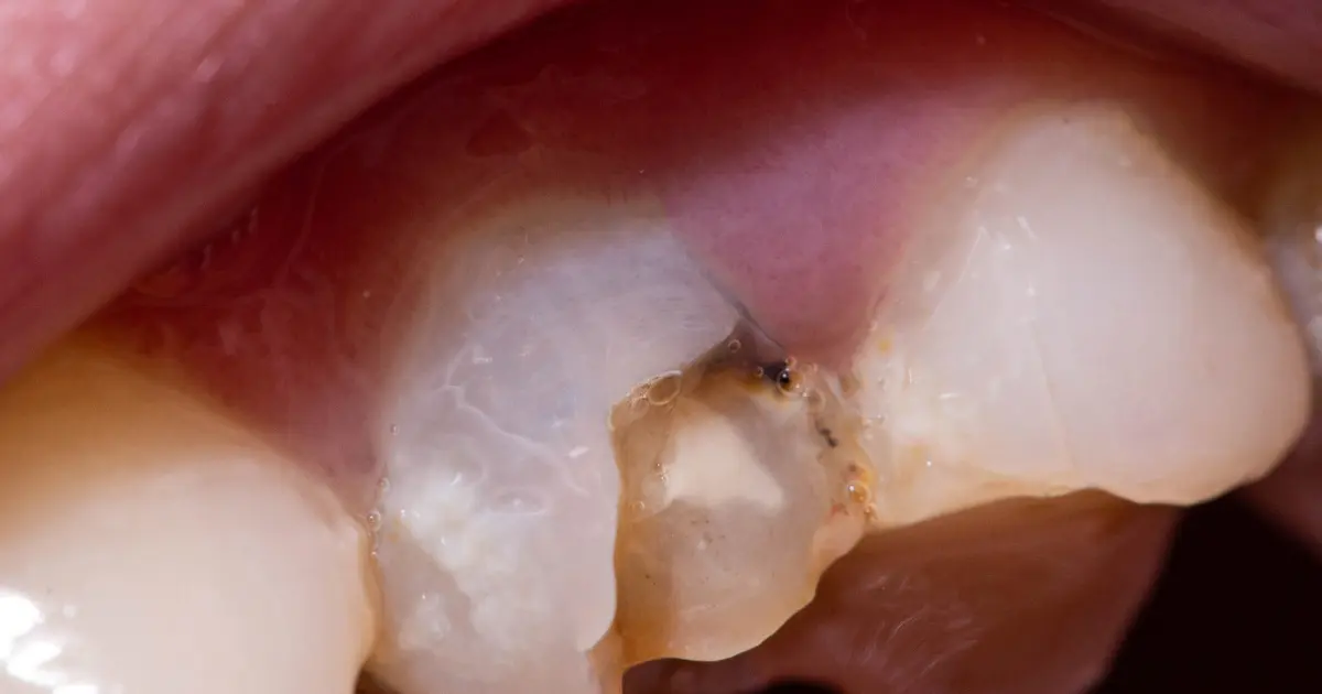 broken tooth