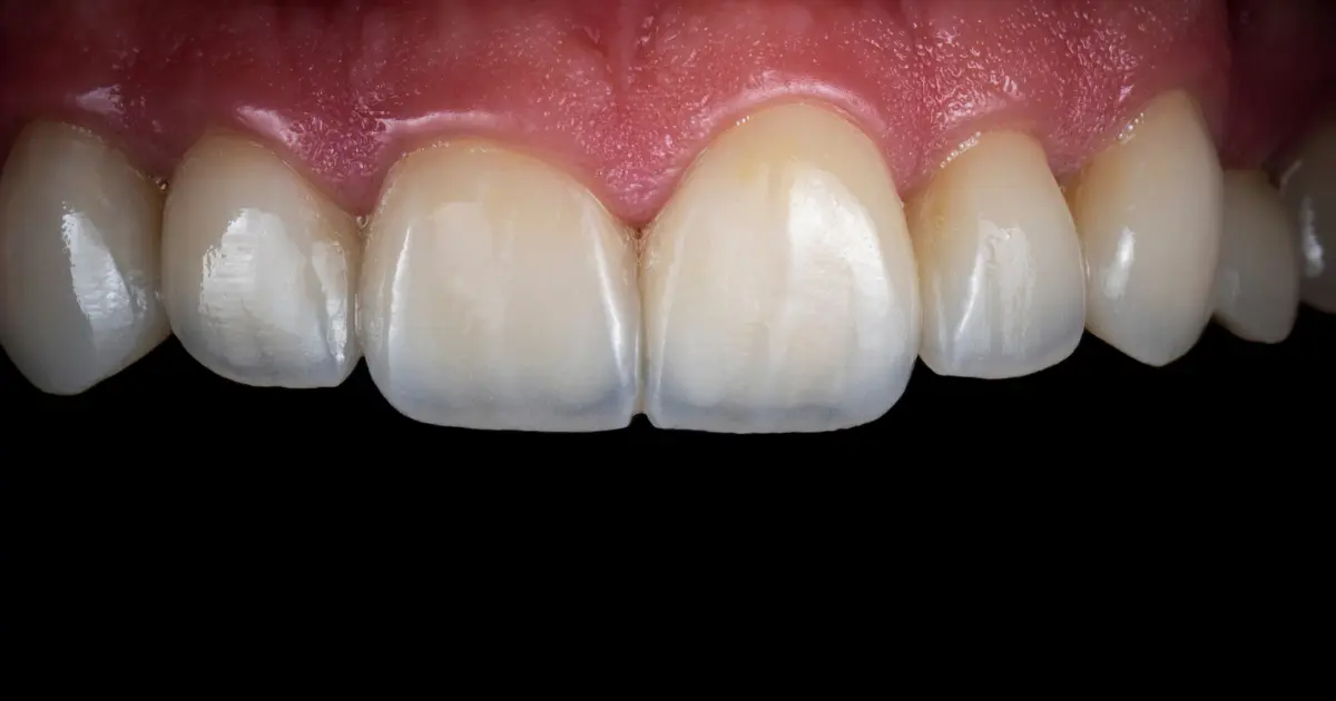 dents translucides