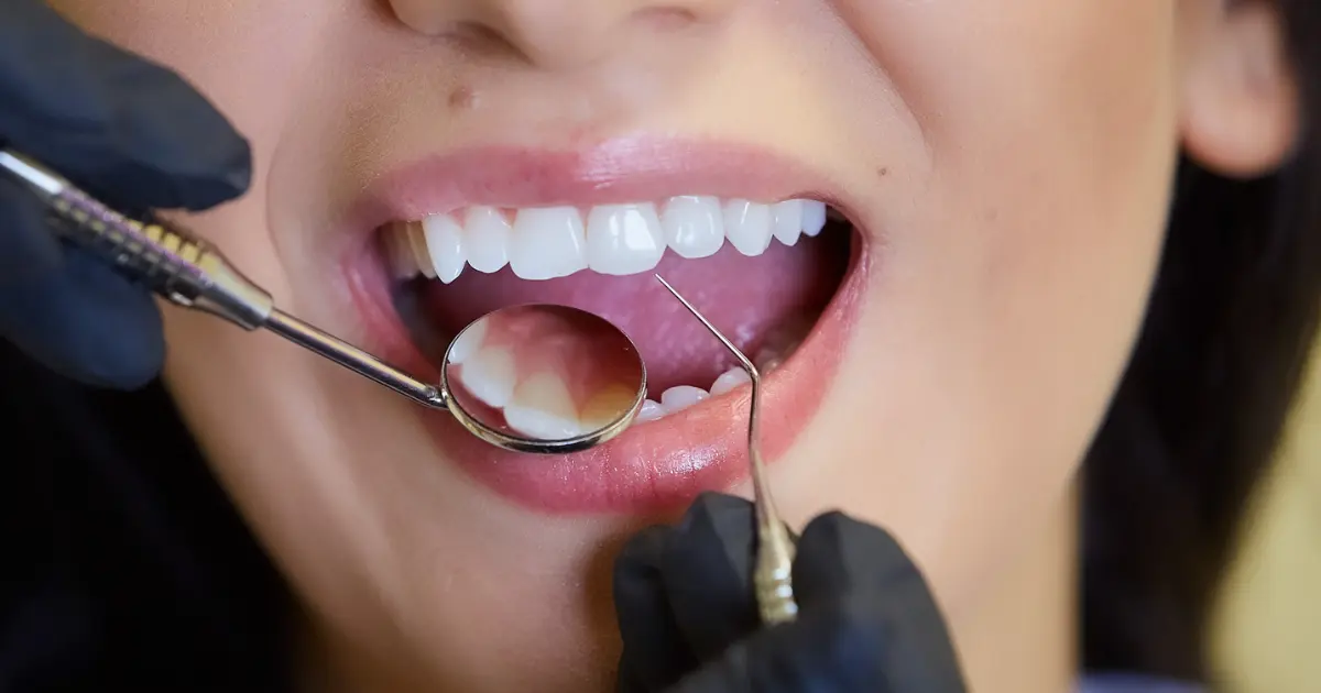 dişler arasındaki boşlukların tedavisi