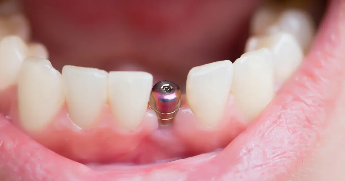 tek diş implantı