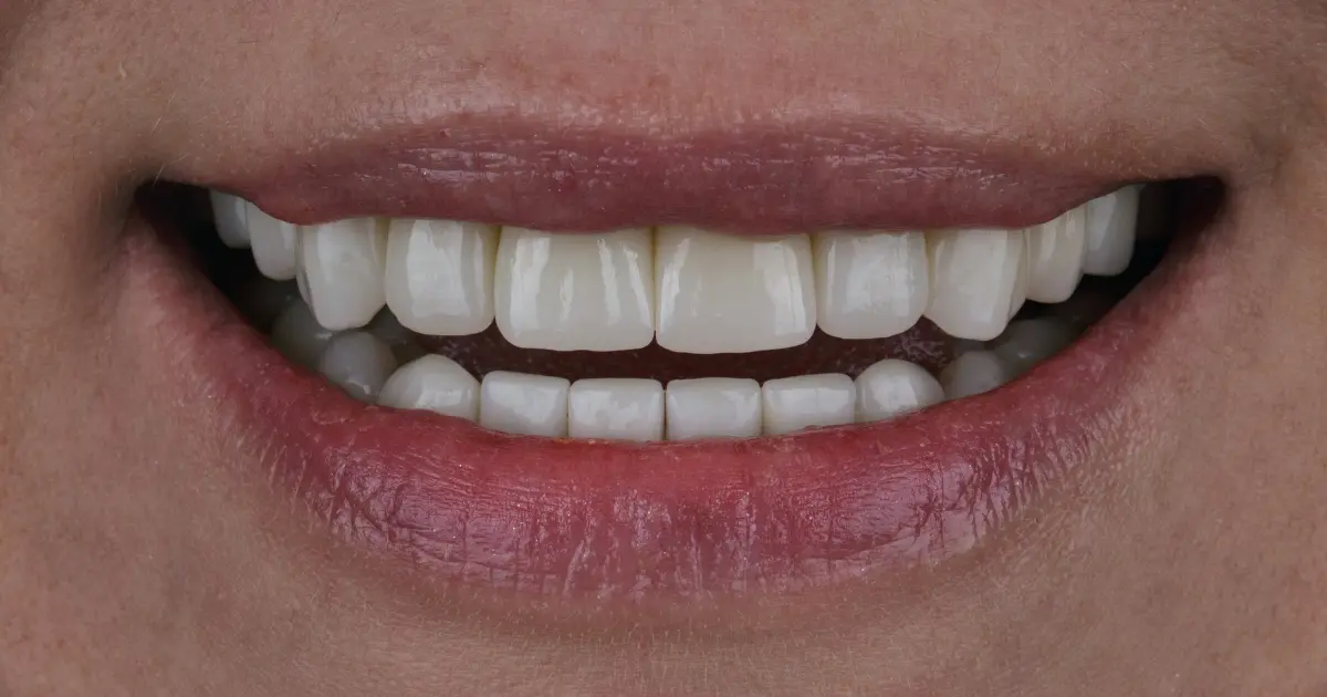 types-of-crowns