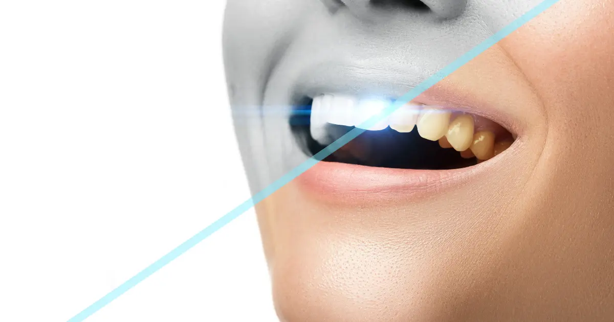 teeth contouring