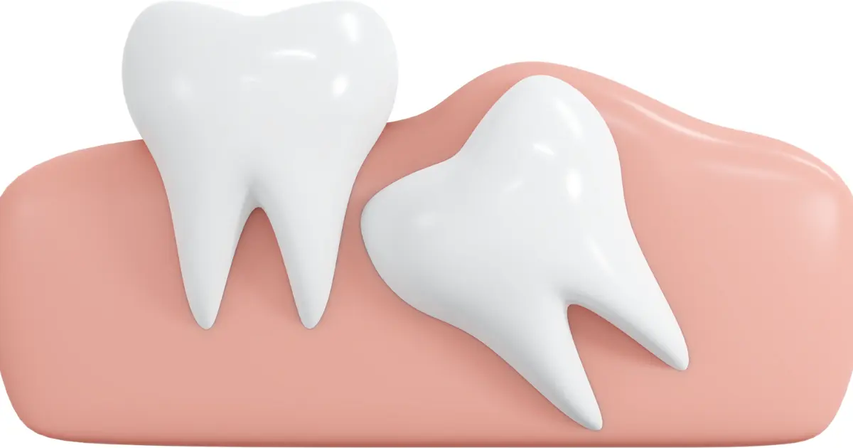 wisdom teeth removal