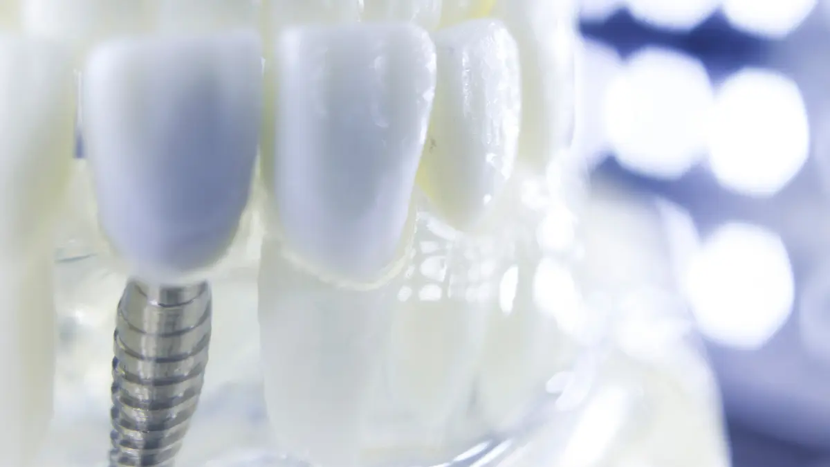 Maintenance of Titanium Dental Implants