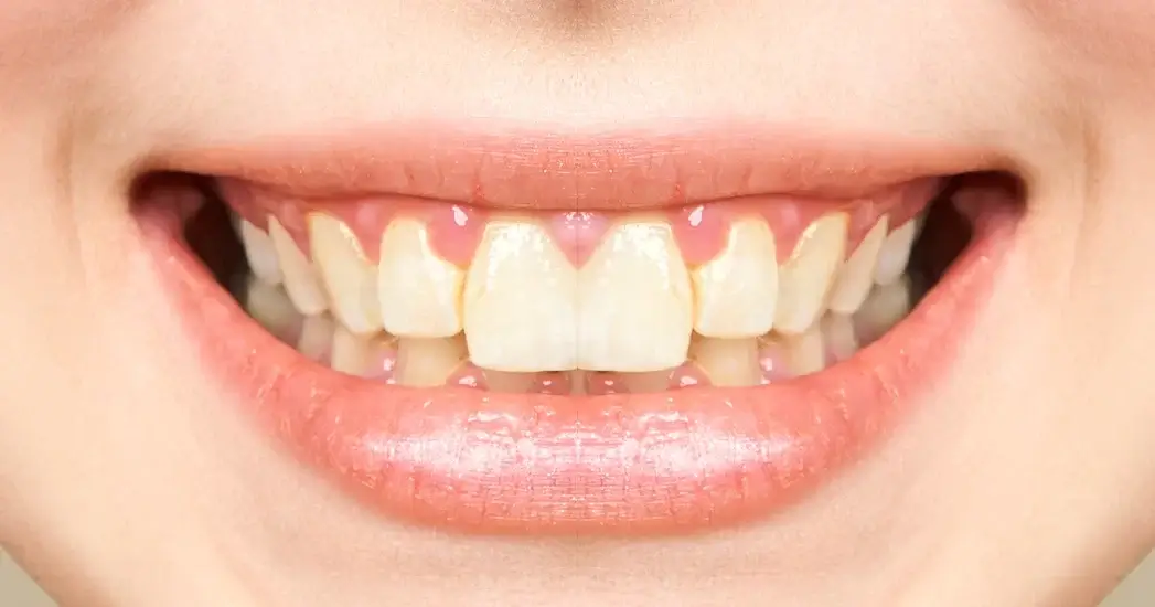 smile dental before