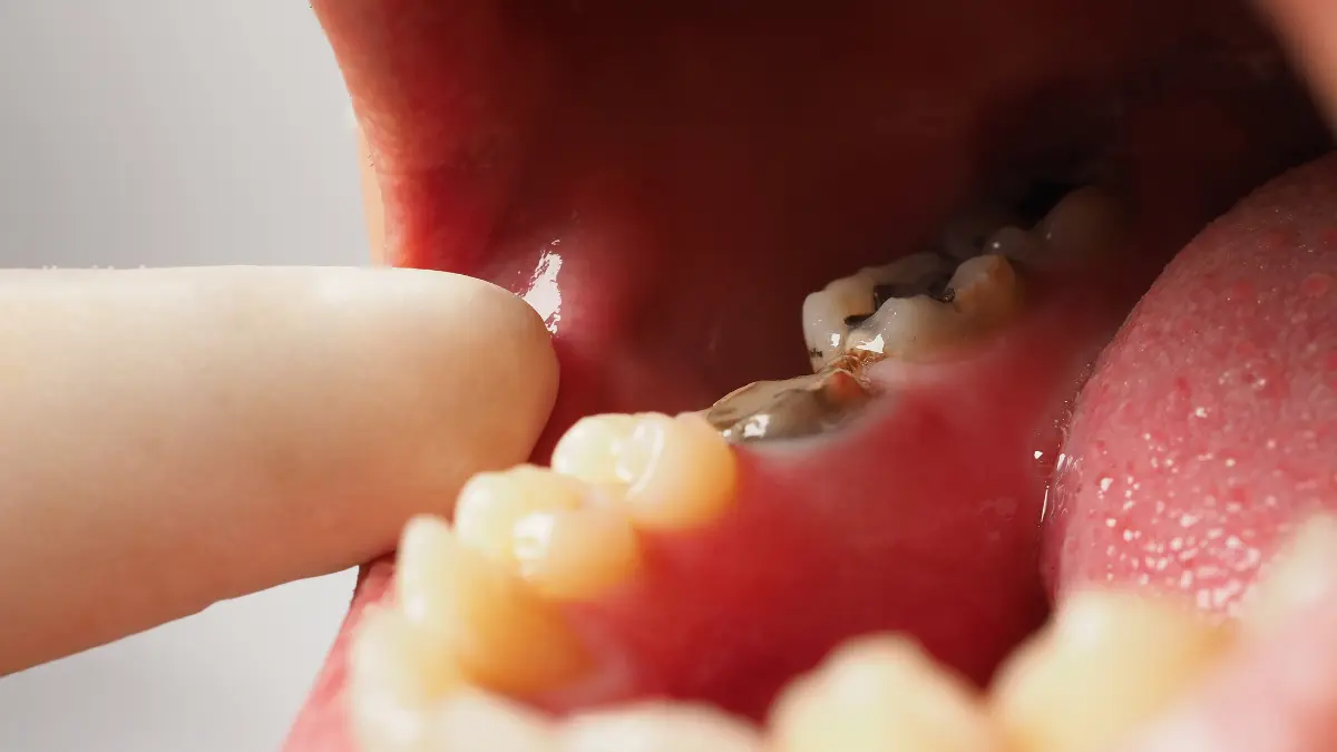 Çürük dişler dolguda acı verir mi?