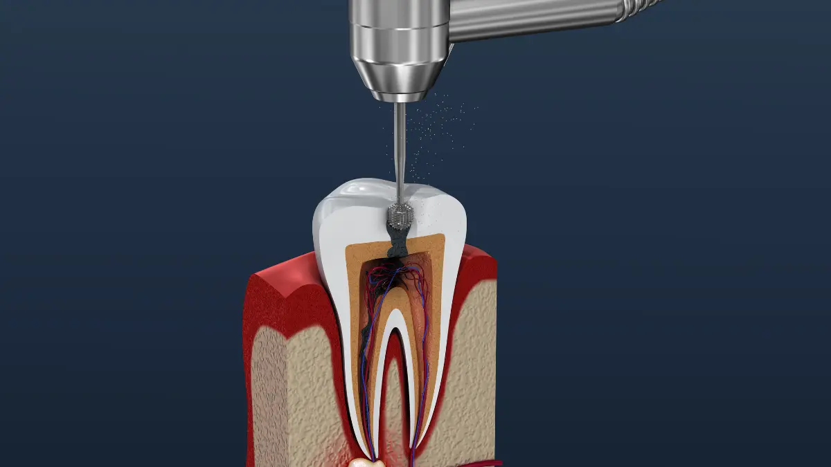 endodonti nedir