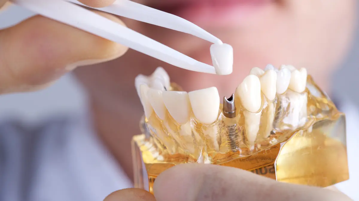Diş implantı nasıl yapılır?