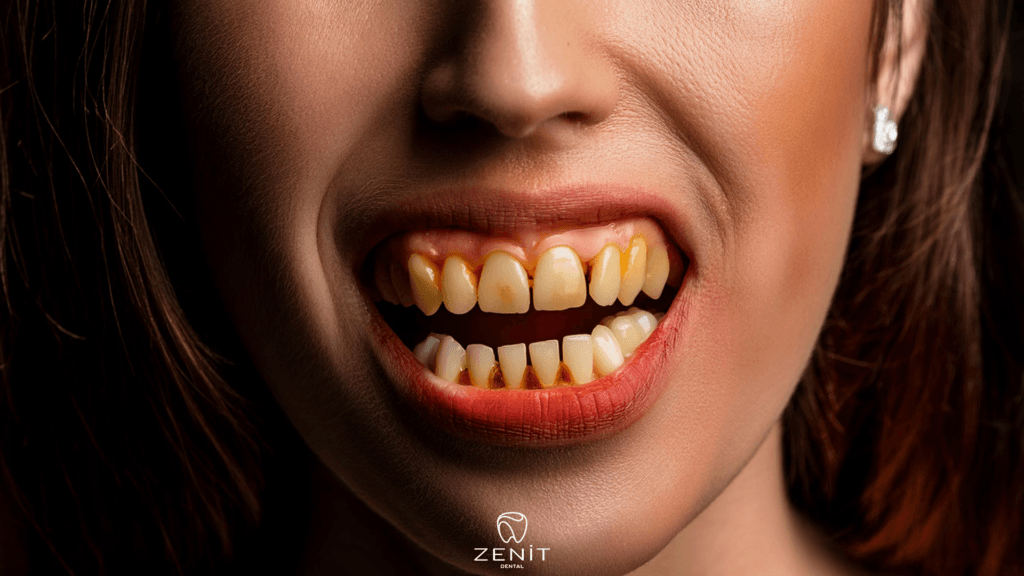 Dişteki Kahverengi Lekeler