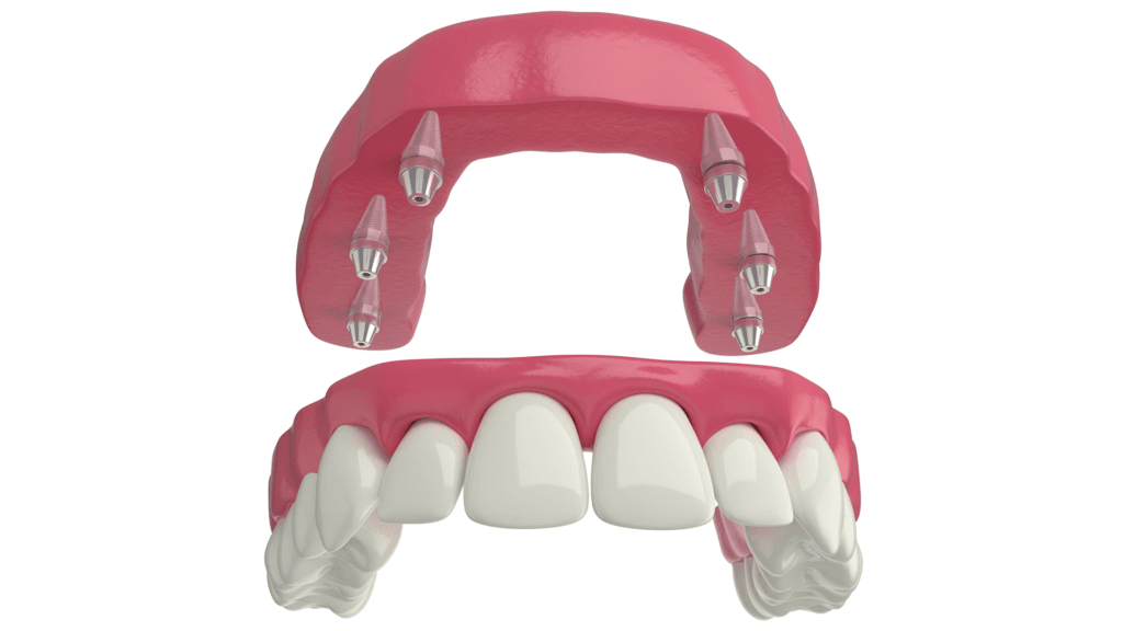 Aynı Gün Takma Dişler