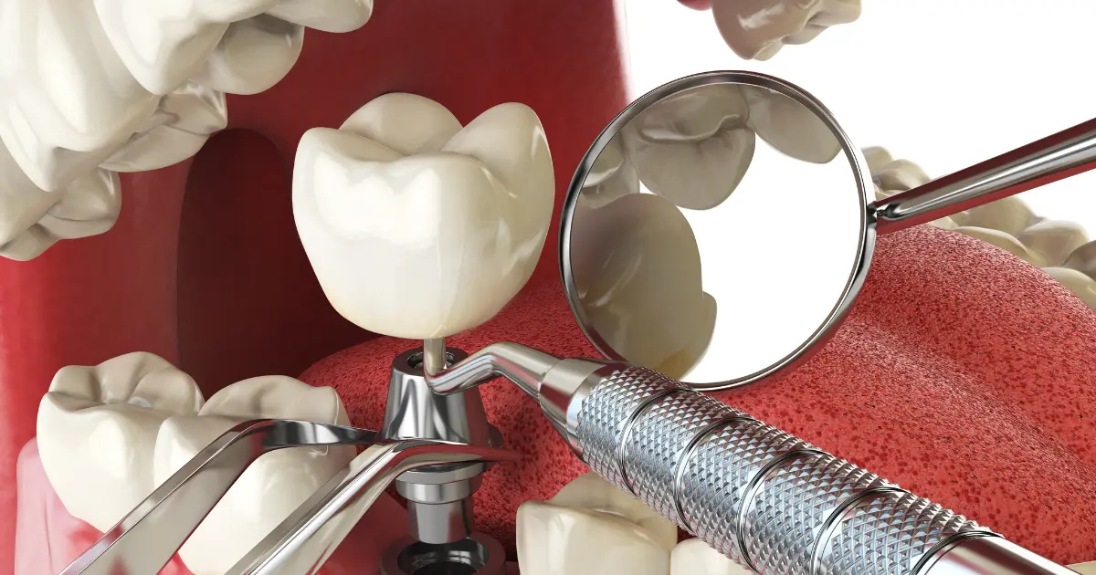 Benefits of Implant Teeth