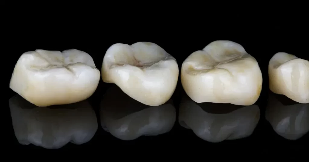 Differences of Dental Inlays and Onlays