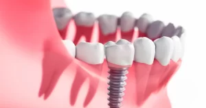 Implant Teeth A Comprehensive Guide