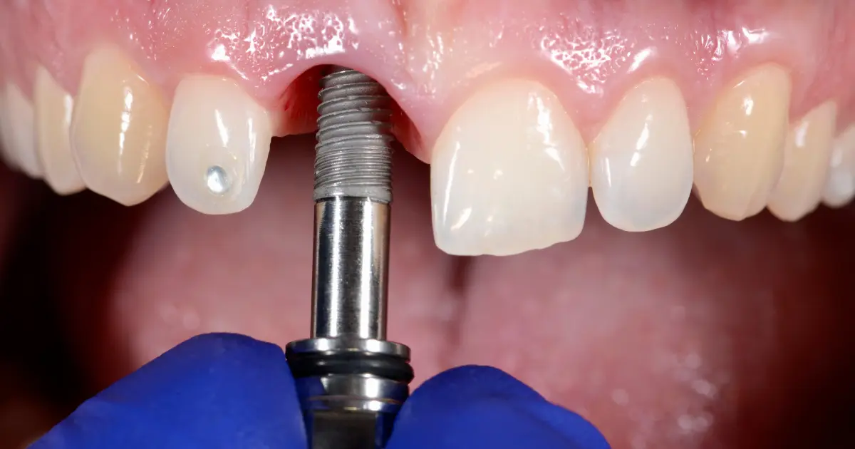 Recovering and Maintaining Implant Teeth
