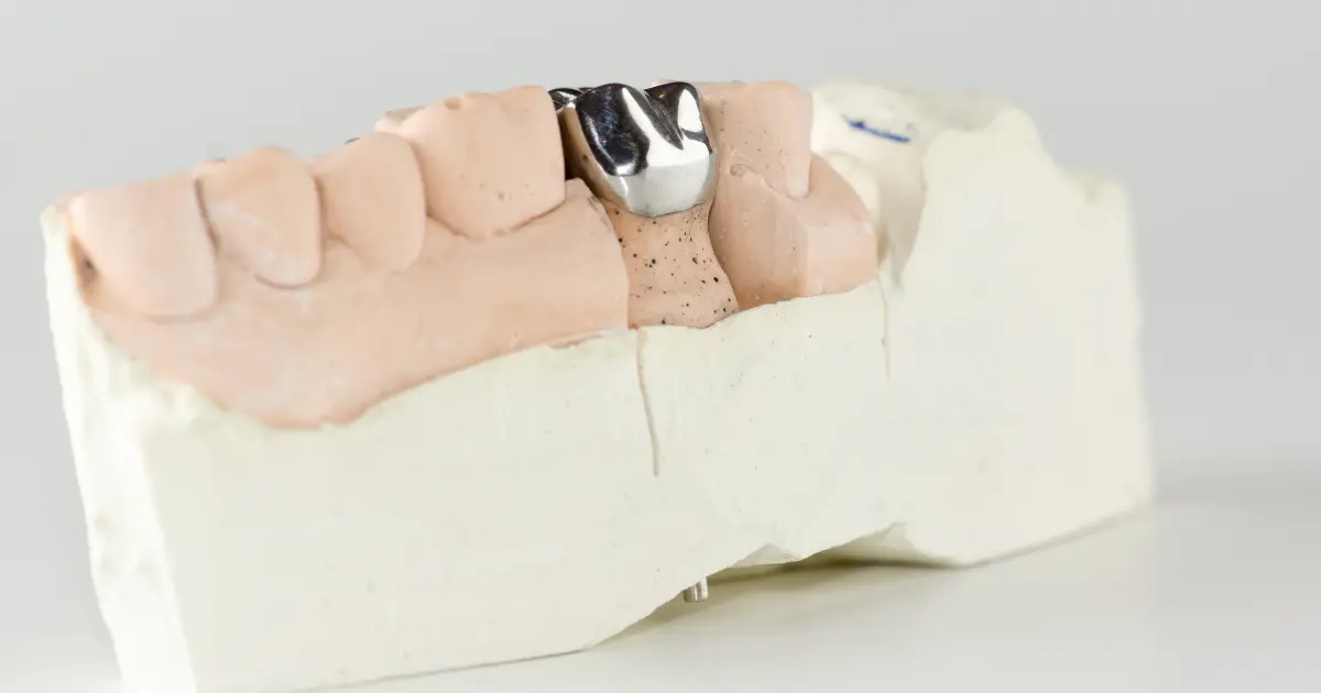 All About Stainless Steel Crown Zenit Dent