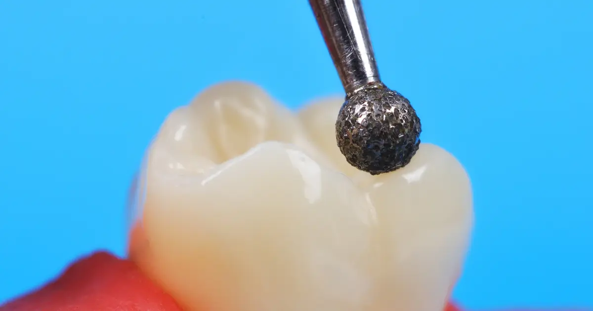 The Different Types of Tooth Abrasion