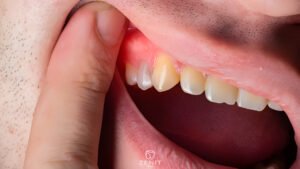 Dental Gum Disease