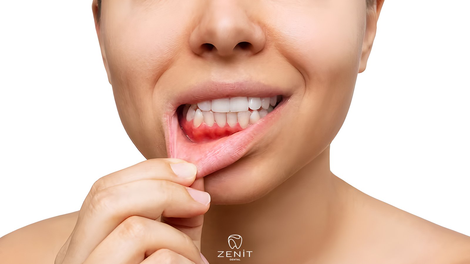 Gum bleeding