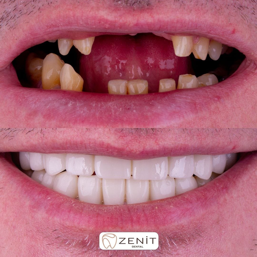 Why Should I Choose Implant Treatment in Turkey?