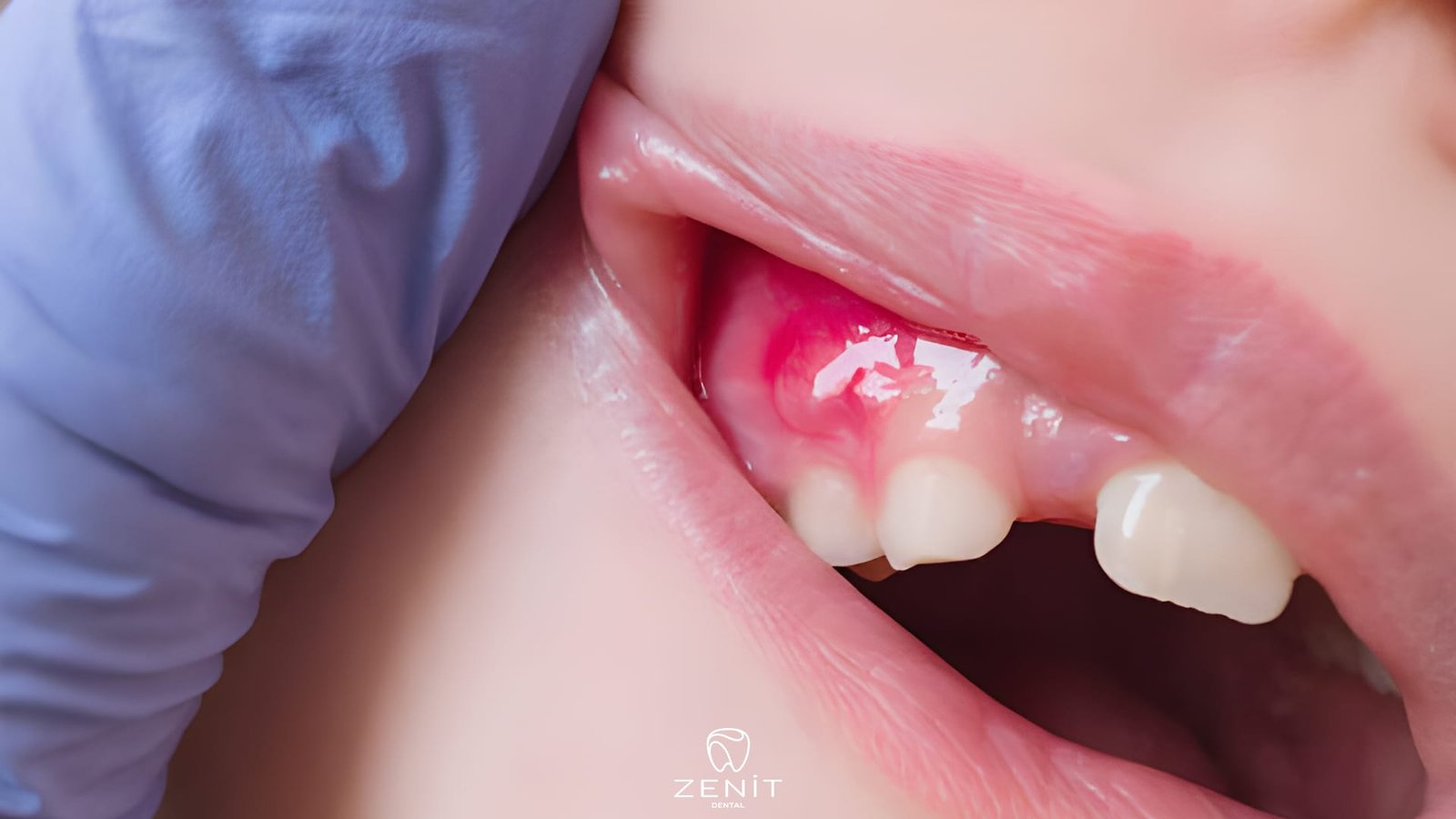 How to Alleviate Toothache Caused by Inflammation