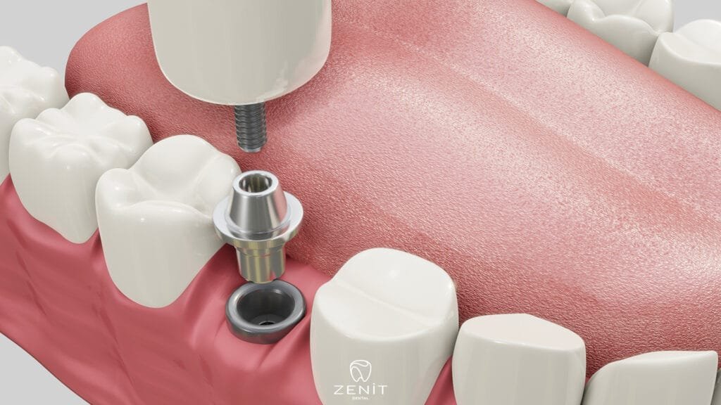 Why Should I Choose Implant Treatment in Turkey?