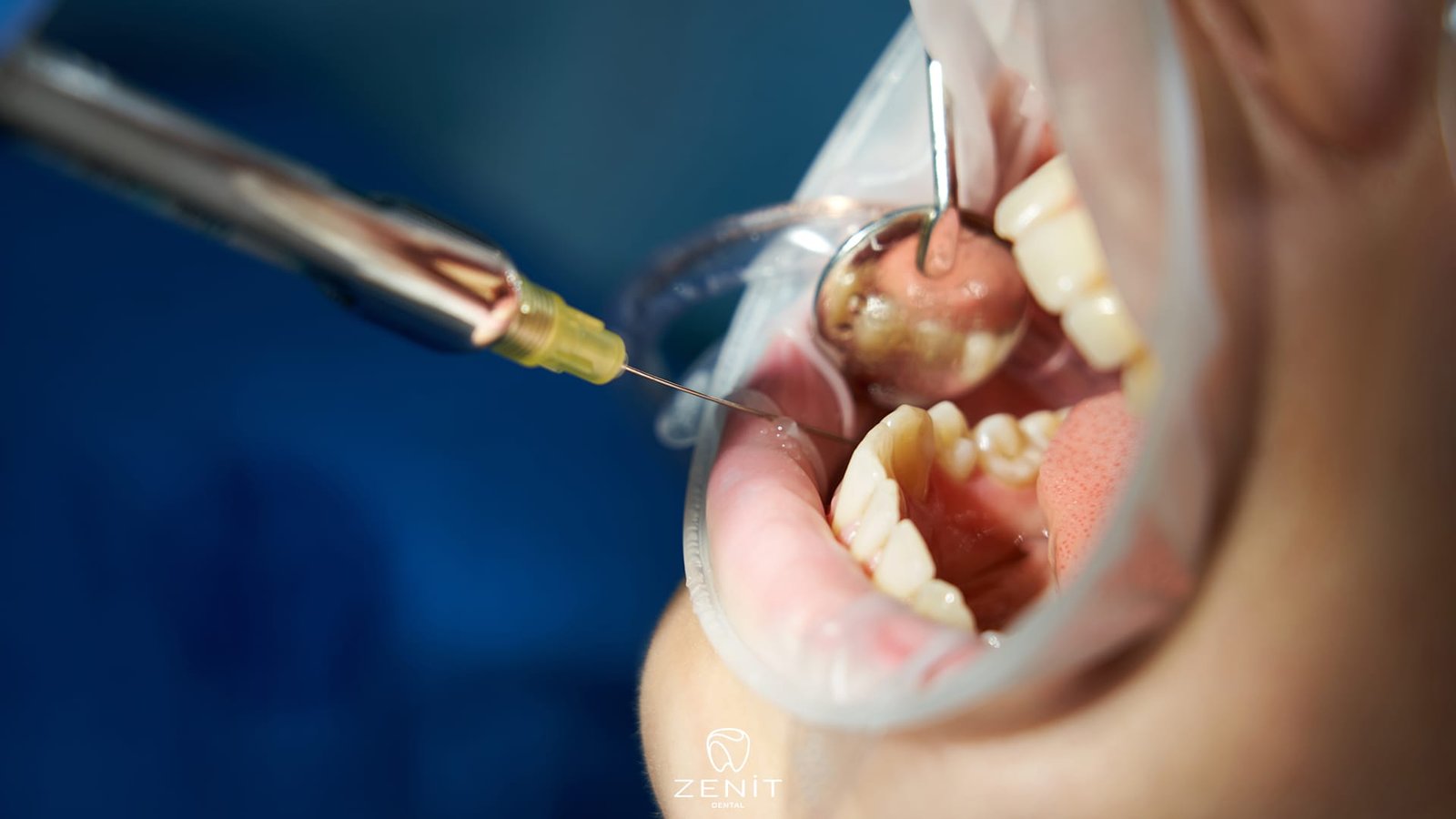 How to Alleviate Wisdom Tooth Pain