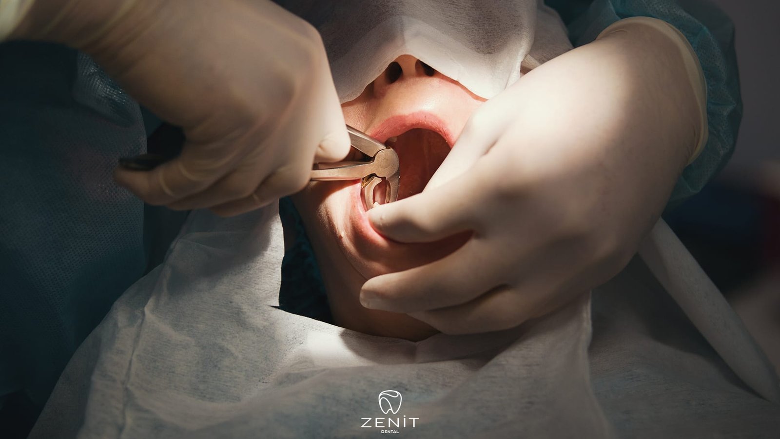 How to Alleviate Wisdom Tooth Pain