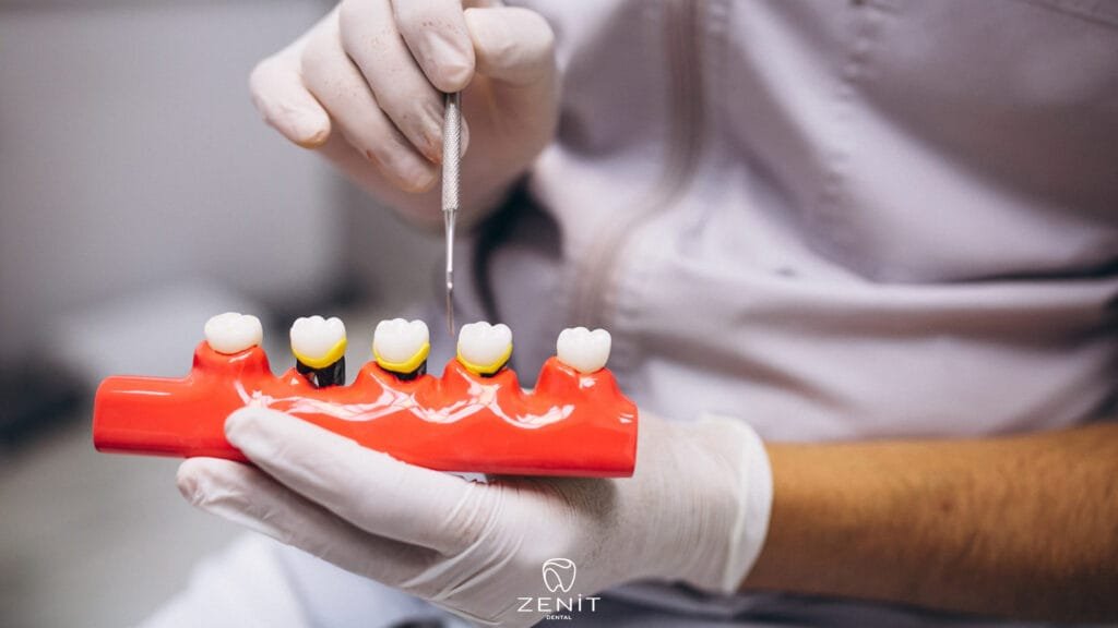 Restoratif Diş Tedavisi