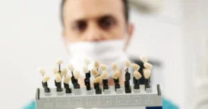 فينير الأسنان