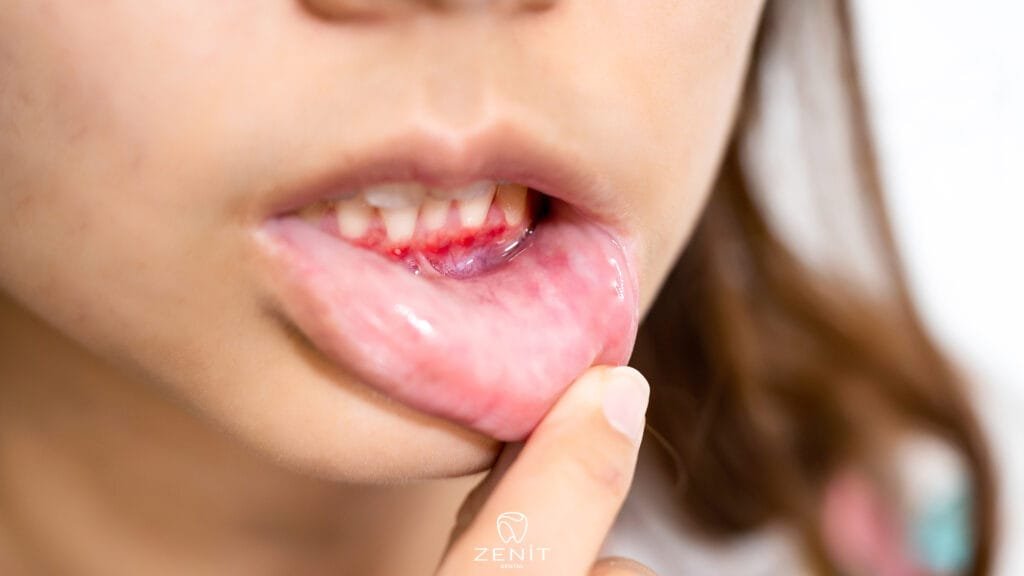 Inflammation in Gums