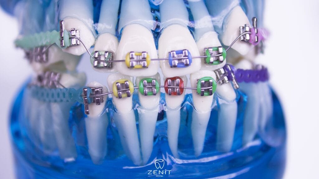 Orthodontic Treatment