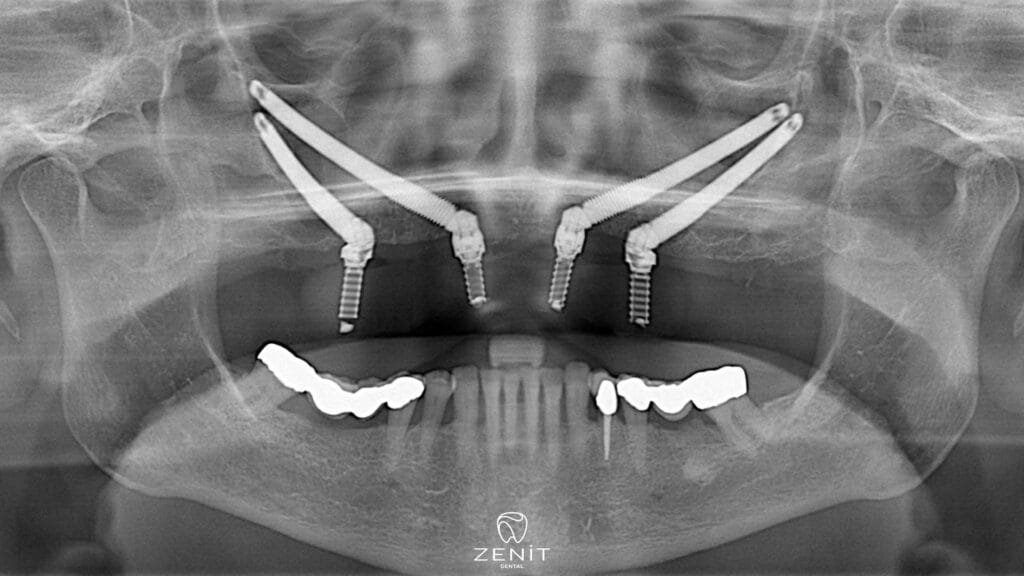 Zygoma-Implantat