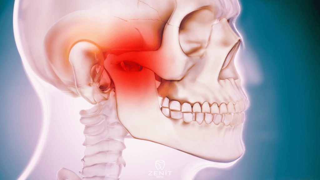 Was verursacht Kieferkontraktionen?