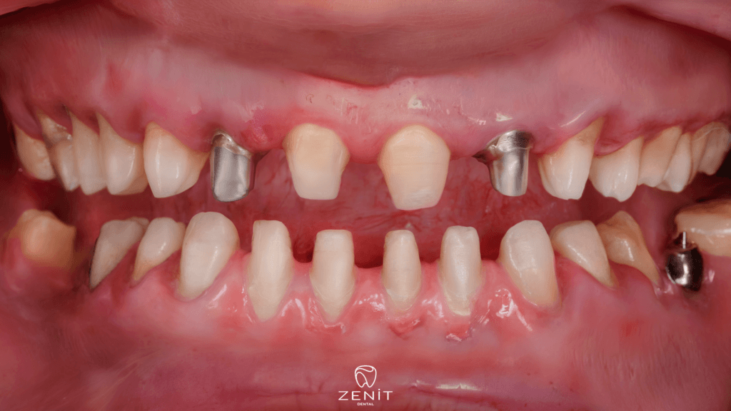 Severe Pain After Tooth Cutting