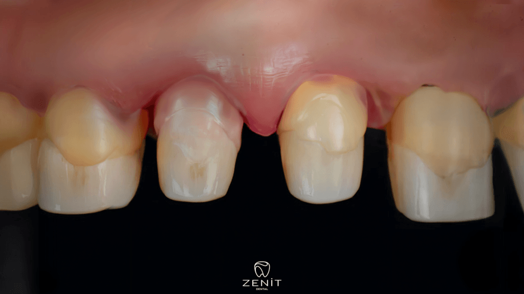 Diş Kesimi Sonrası Şiddetli Ağrı